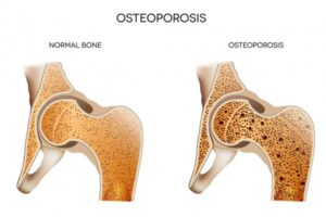 osteoporosis, menopause