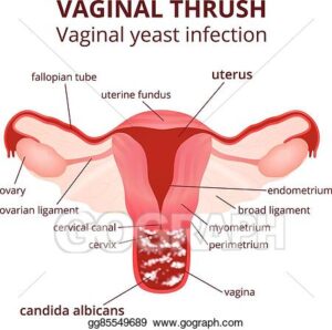 vaginal thrush, candida